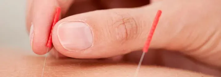 Chiropractic Komoka ON Acupuncture Hero Hands placing acupuncture needles.